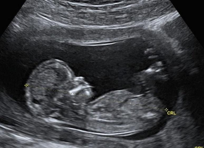 Что показывает первый скрининг в 12 недель