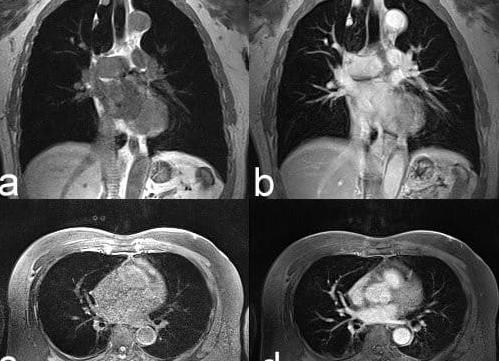 Что показывает мрт легких