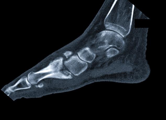 Что показывает кт стопы