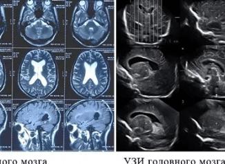 Что лучше мрт или узи