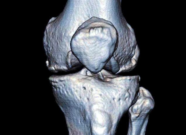 Что лучше мрт или кт коленного сустава