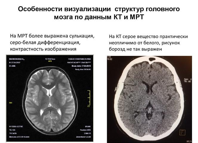 Что лучше кт или мрт головы