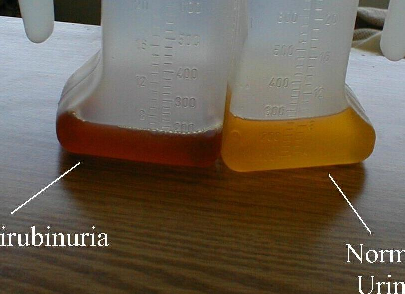 Билирубин отрицательный в моче что это значит