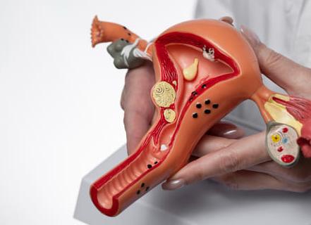 Анализ крови са 125 при кисте яичника