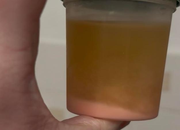 Аморфные кристаллы в моче что это значит