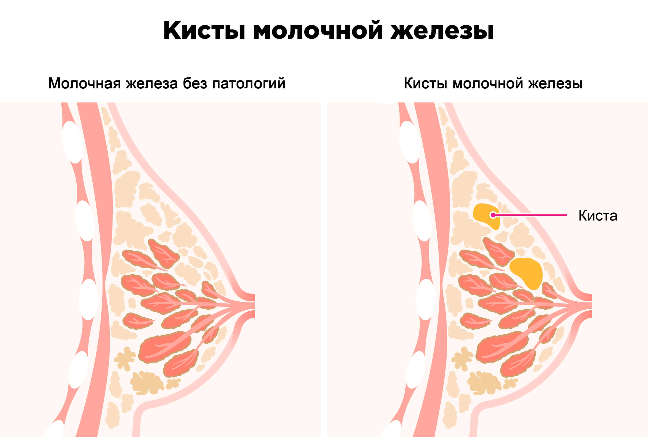 Как избавиться от кисты в молочной железе