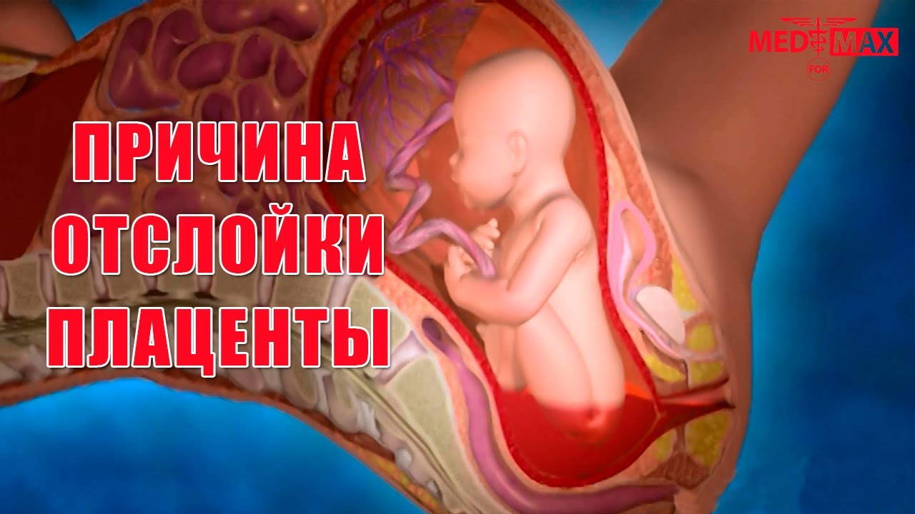 Как отслойка плаценты проявляется