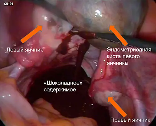 Киста эндометриоидная яичника