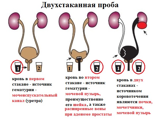 Микрогематурия у мужчин