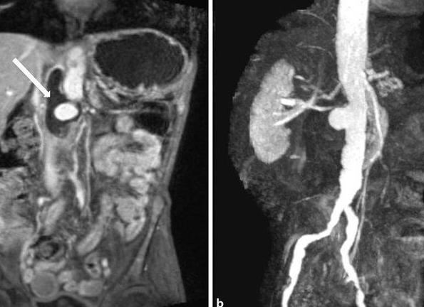 Мрт брюшной полости с контрастом что показывает