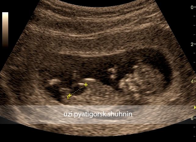 Мочевой пузырь у плода увеличен