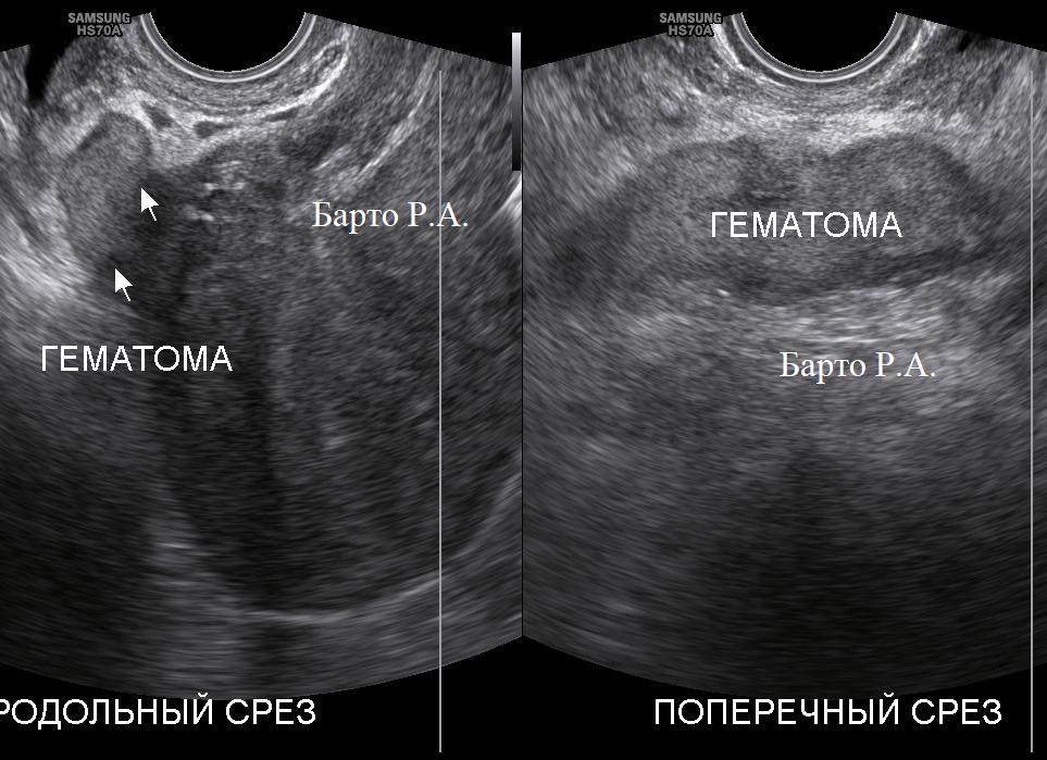 Матка после кесарева сечения фото внутри