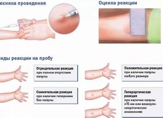 Манту у ребенка результат