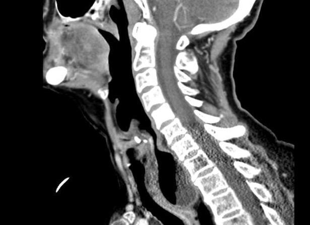 Кт шейного отдела позвоночника Кт шейного отдела позвоночника