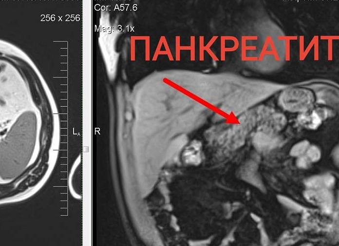Кт или мрт поджелудочной железы что лучше