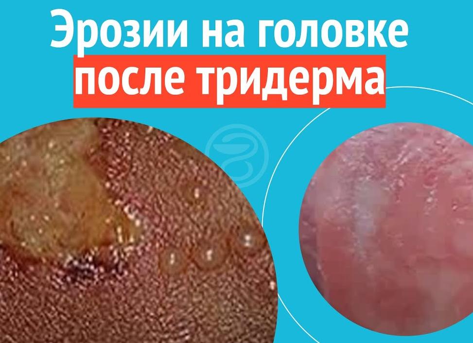 Крем тридерм баланопостит Крем тридерм баланопостит