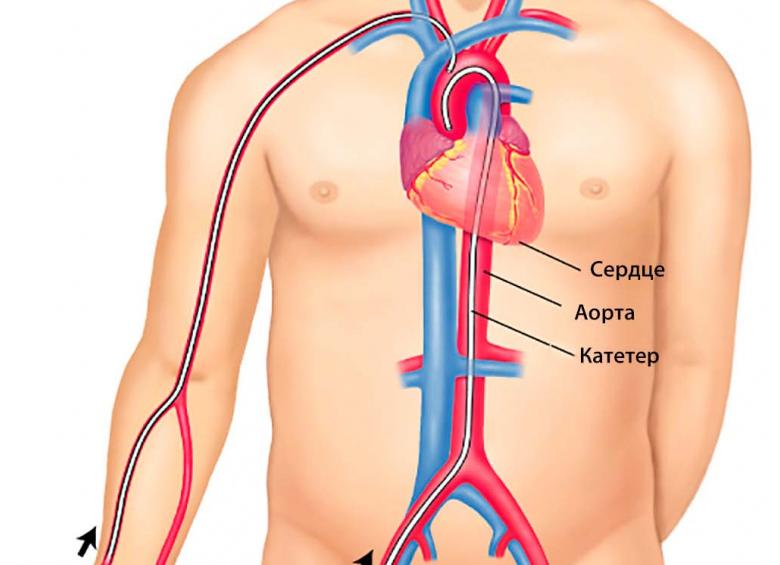 Коронарное исследование сосудов сердца