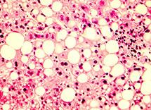 Изменения в печени