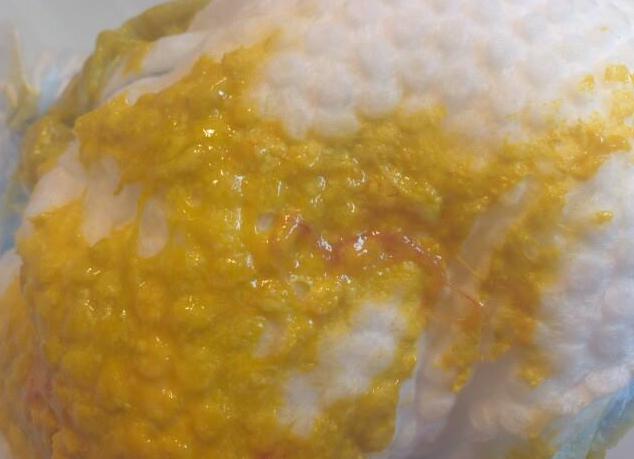 Эритроциты в кале у грудничка