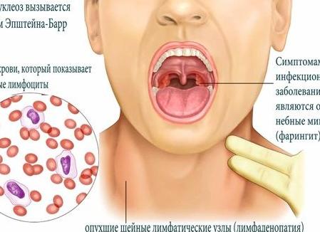 Эпштейн барра анализ