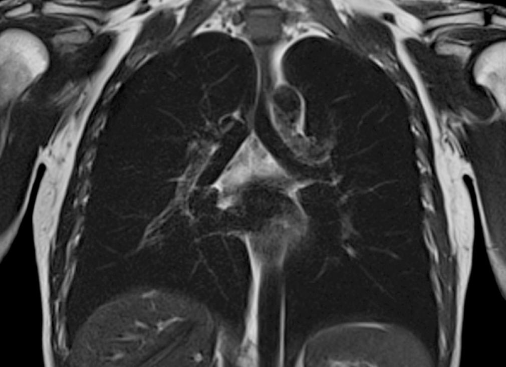 Что такое мрт легких фото