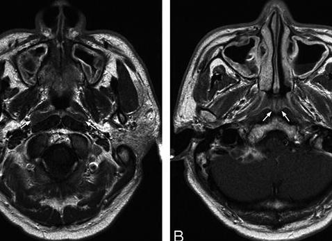 Что показывает мрт носовых пазух Что показывает мрт носовых пазух