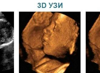 Чем узи отличается от скрининга