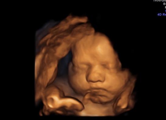 3 скрининг во сколько недель