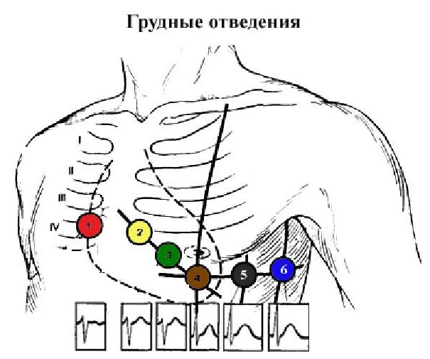 Как делать экг