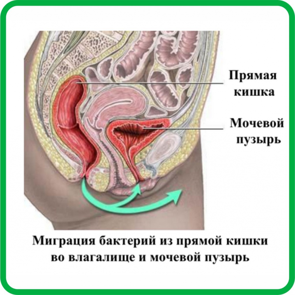 Кишечная палочка в моче