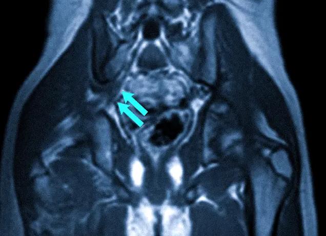 Мрт седалищного нерва