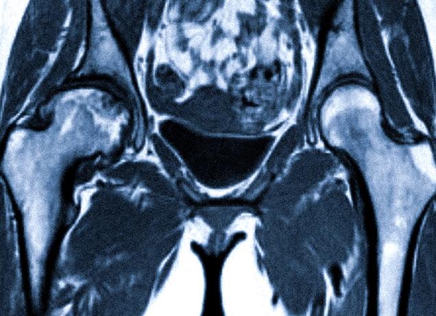 Мрт костей таза