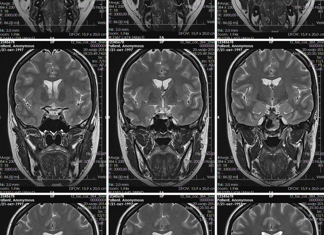 Мрт гипофиза без контраста что показывает