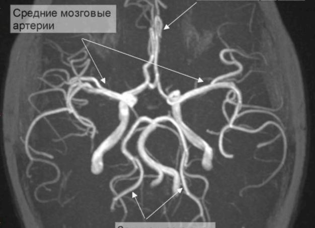 Мр ангиография интракраниальных артерий Мр ангиография интракраниальных артерий