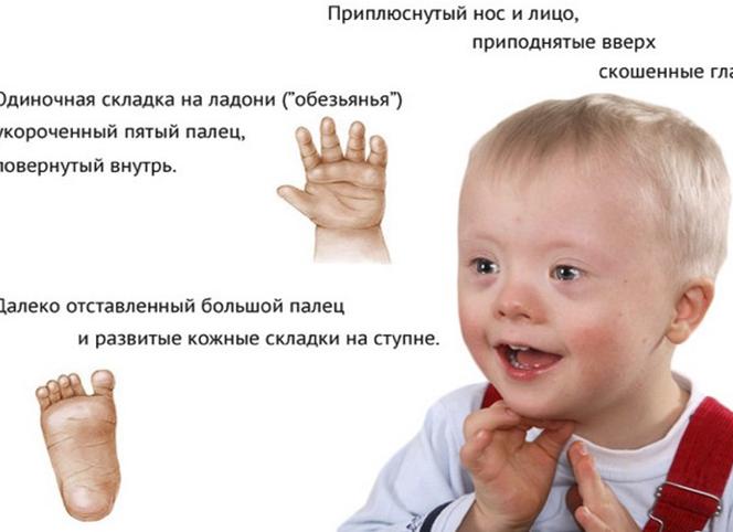 Можно ли определить синдром дауна по узи
