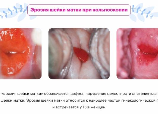 Кровит шейка матки при осмотре причины