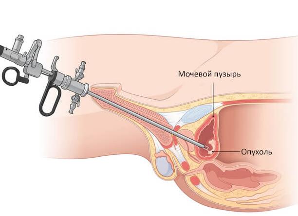 Какие анализы берет уролог у мужчин