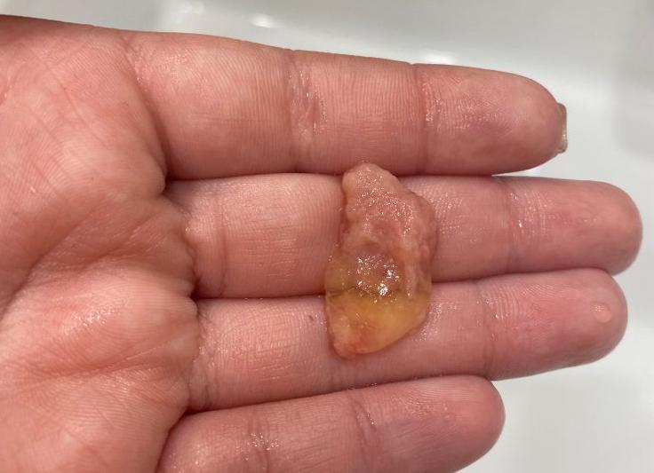 Как выглядит плодное яйцо при медаборте фото