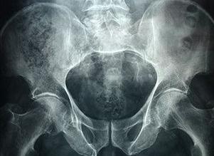 Как подготовиться к рентгену копчика