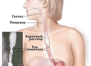 Как обследовать пищевод и гортань Как обследовать пищевод и гортань