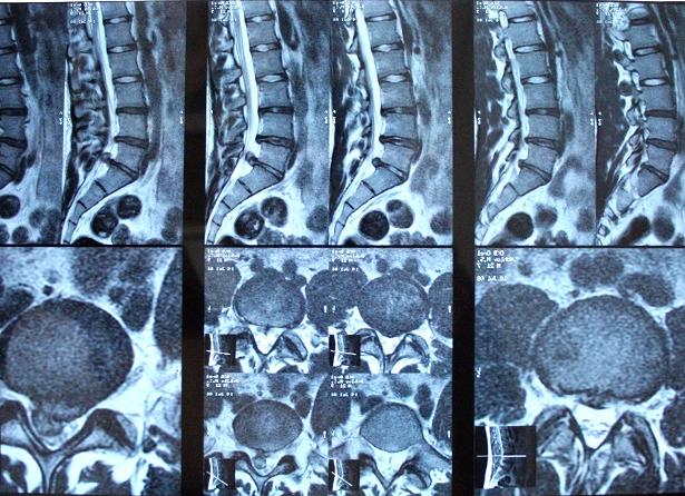 Как готовиться к мрт пояснично крестцового отдела позвоночника