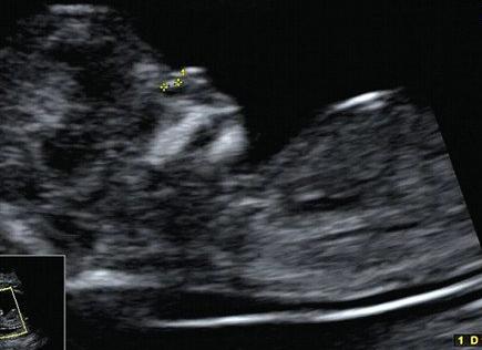 Гипоплазия носовой кости у плода 12 недель