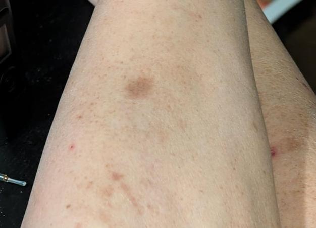 Что такое стафилококк и откуда он появляется