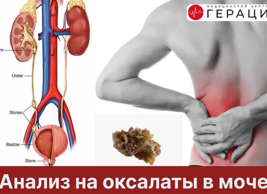 Что такое оксалаты