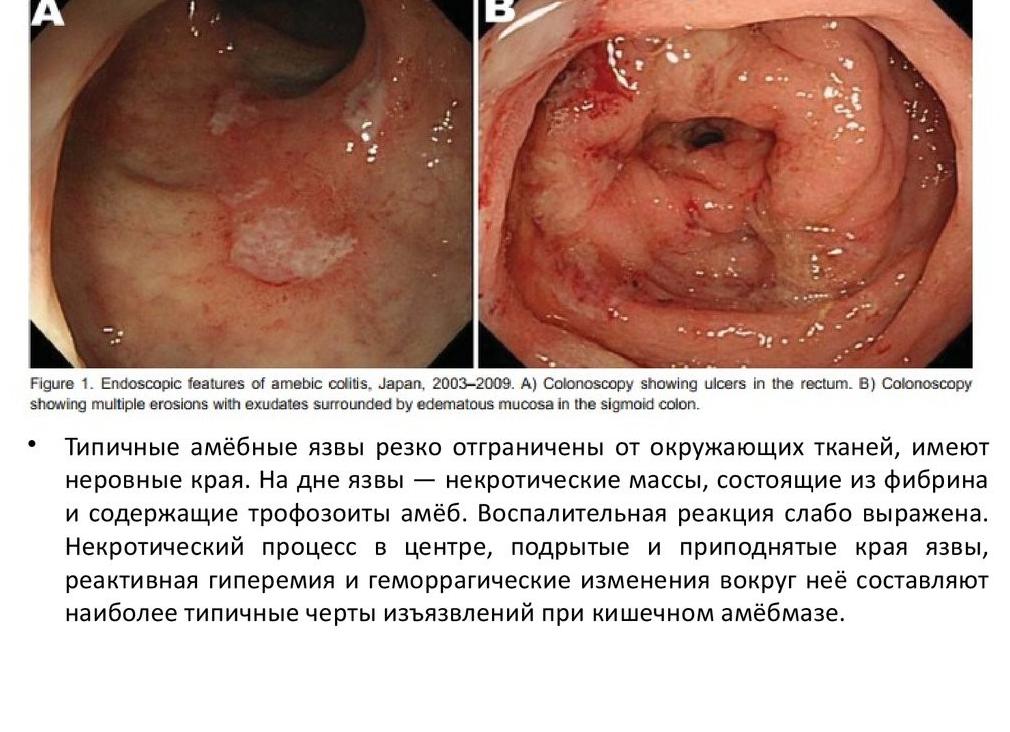 Что такое кишечный амебиаз
