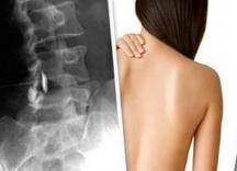 Что показывает узи позвоночника