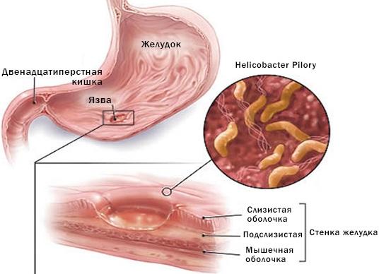 Чем лечить хеликобактерную инфекцию в желудке Чем лечить хеликобактерную инфекцию в желудке