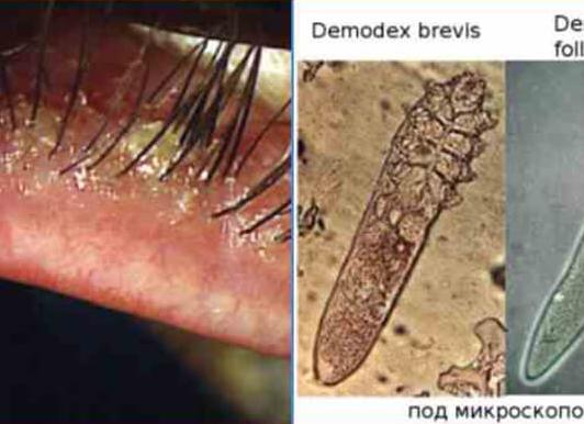 Анализ на демодекс подготовка