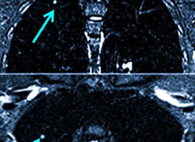 Мрт легких при туберкулезе