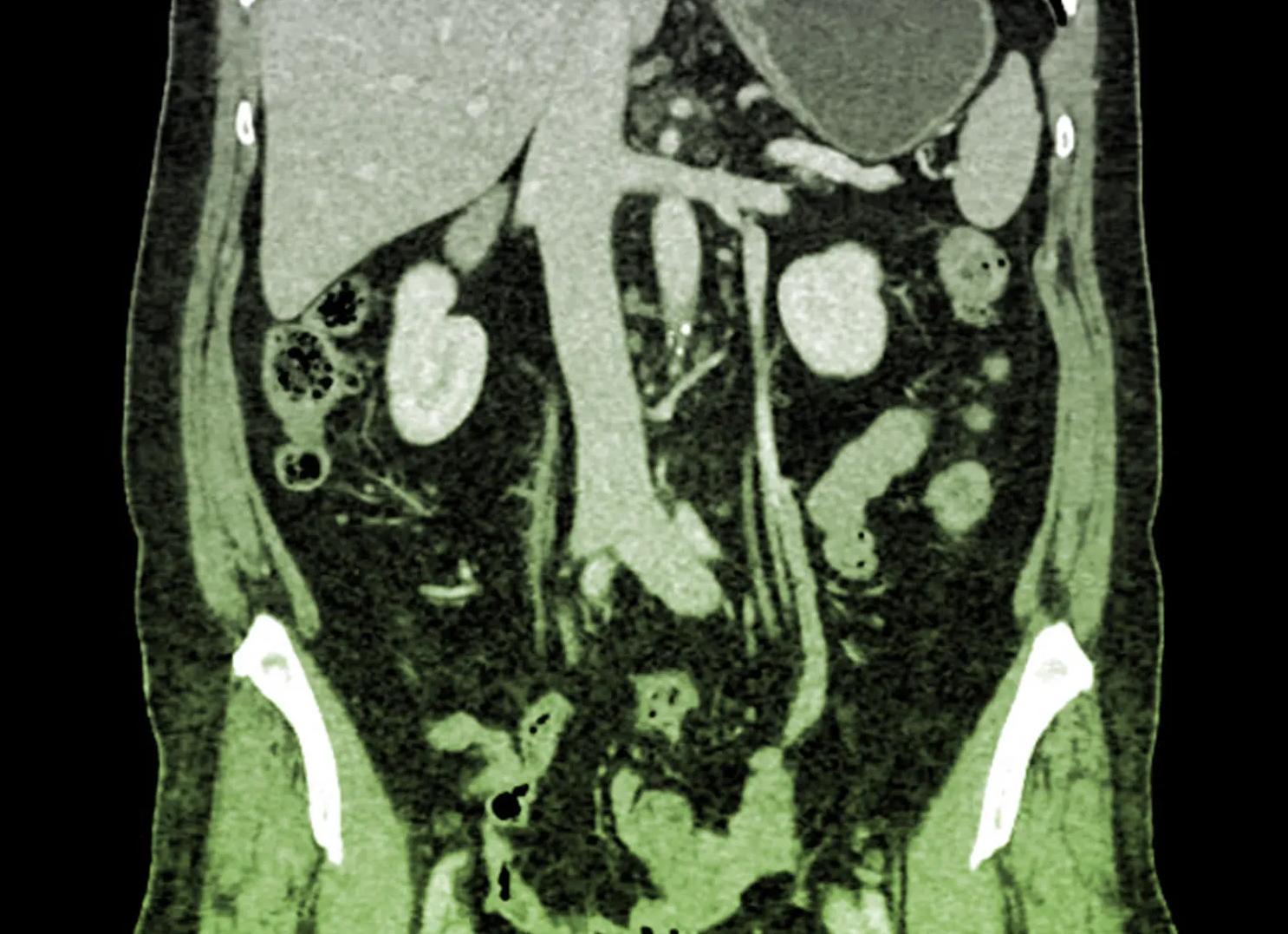 Мрт брюшной полости и органов малого таза